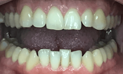 Before treatment - Invisalign