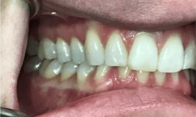 Before treatment - Invisalign