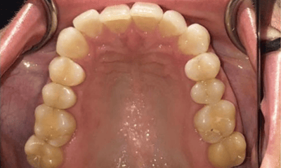 Before treatment - Invisalign
