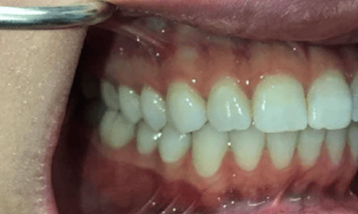 Before treatment - Invisalign