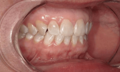 Before treatment - Invisalign