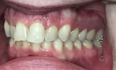 Before treatment - Invisalign