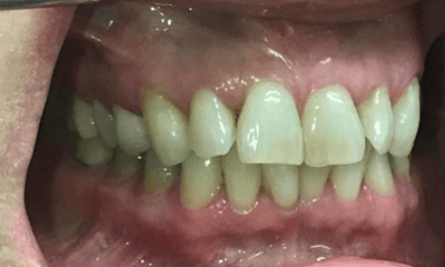 Before treatment - Invisalign