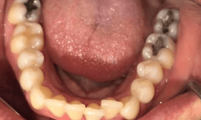 Before treatment - Invisalign & Anterior Bonding 