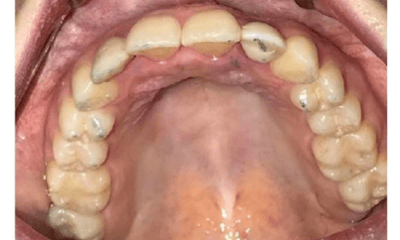 Before treatment - Invisalign