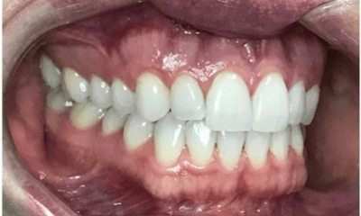 Before treatment - Invisalign