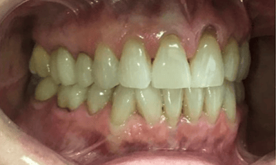 Before treatment - Invisalign