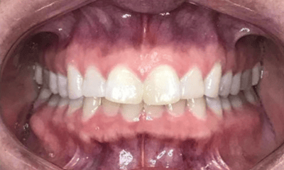 Before treatment - Invisalign