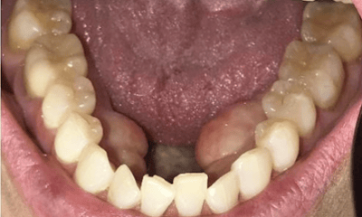 Before treatment - Invisalign