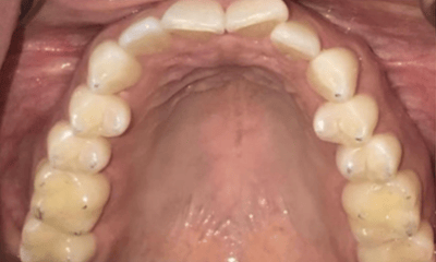 Before treatment - Invisalign