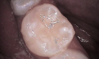 Before treatment - Lower Tooth Composite Fillings