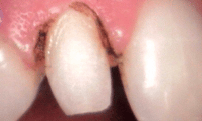 Before treatment - Peg Lateral Restoration