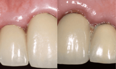 Before treatment - Smile Makeover Crown