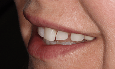 Before treatment - Smile Transformation 