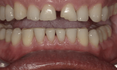 Before treatment - Trial Smile Makeover