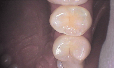 Before treatment - Upper Tooth Composite Fillings
