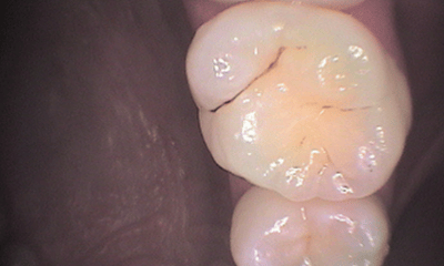 Before treatment - Upper Tooth Composite Fillings