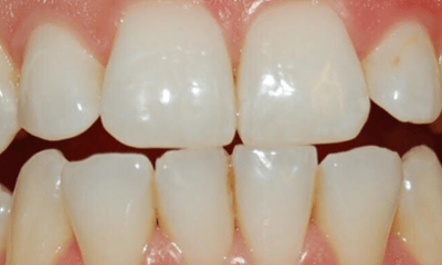 Before treatment - Whitening