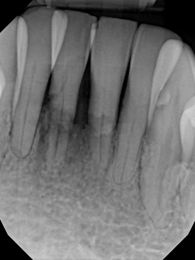 Digital x-ray-traumatic fracture & resorption