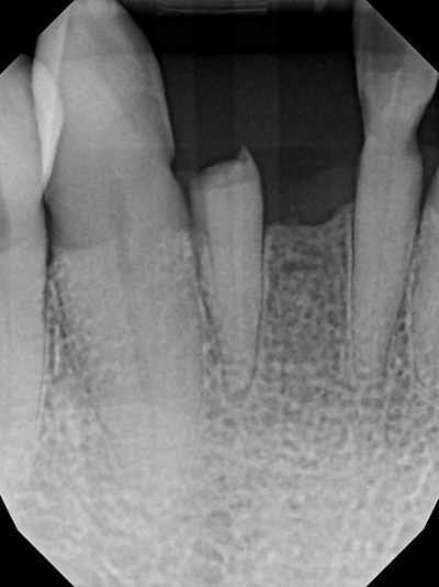 Before treatment - Implant Bridge
