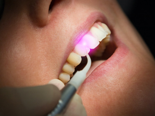 Laser Dentistry